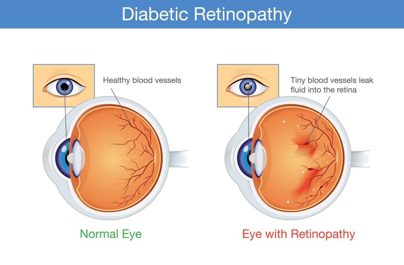 Medical illustration of diabetic retinopathy.