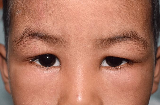 boy with upper eyelid edema (blepharochalasis)