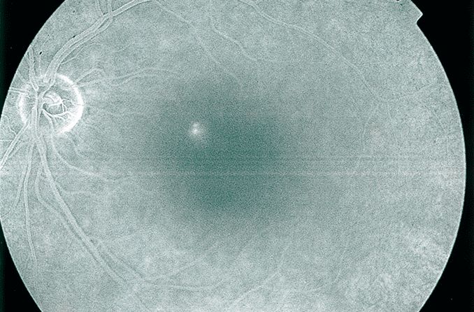 Fluorangiography showing left eye with central serous chorioretinopathy