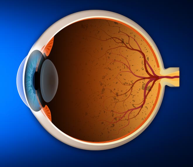 retinitis definition