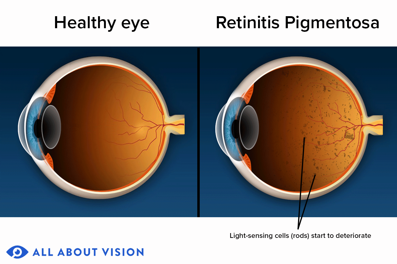retinitis pigmentosa before and after
