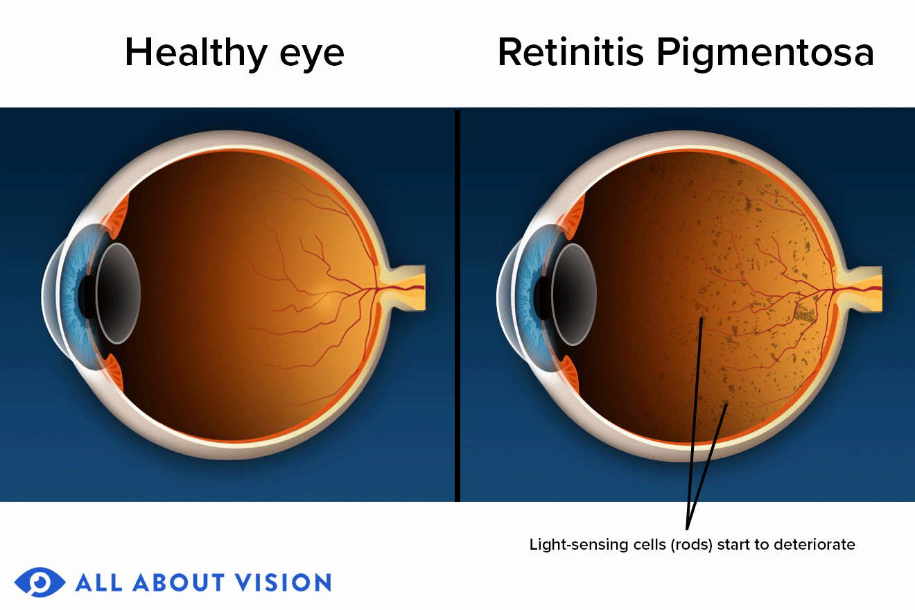 people with retinitis pigmentosa