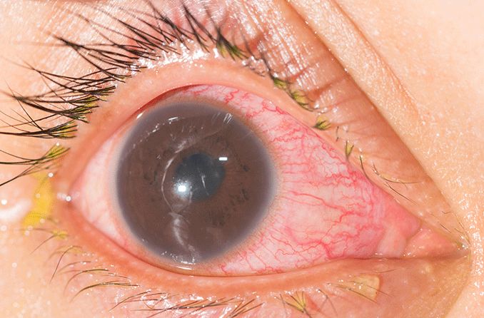 closeup of an eye with iritis (anterior uveitis)