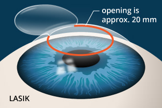 SMILE Eye Surgery: What's Different Than LASIK?