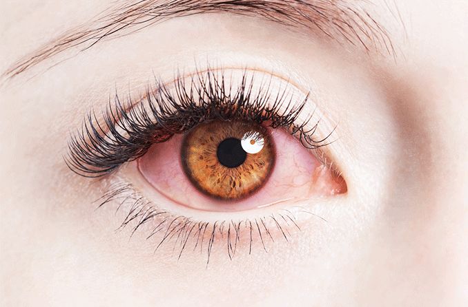 closeup of an infected eye from makeup
