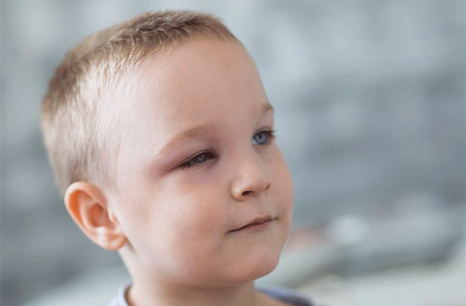 young boy with periorbital edema on one eye