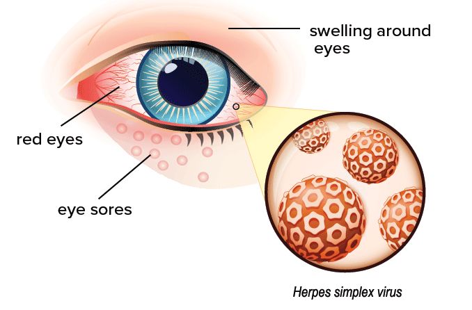 illustration of eye herpes and its symptoms