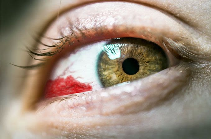 Blood hemorrhage in eye