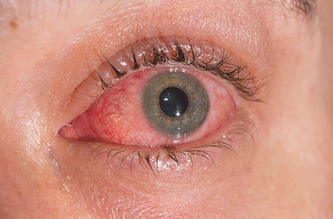 closeup of an inflamed and red eye with conjunctivitis (pink eye)