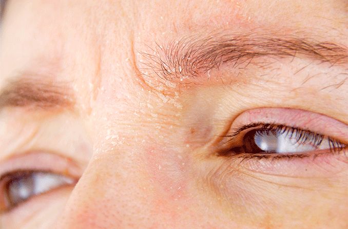Nahaufnahme von Augenlidern und Augenbrauen mit trockener Haut