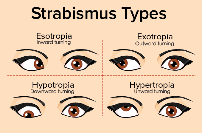 strabismus-types-678x446.gif