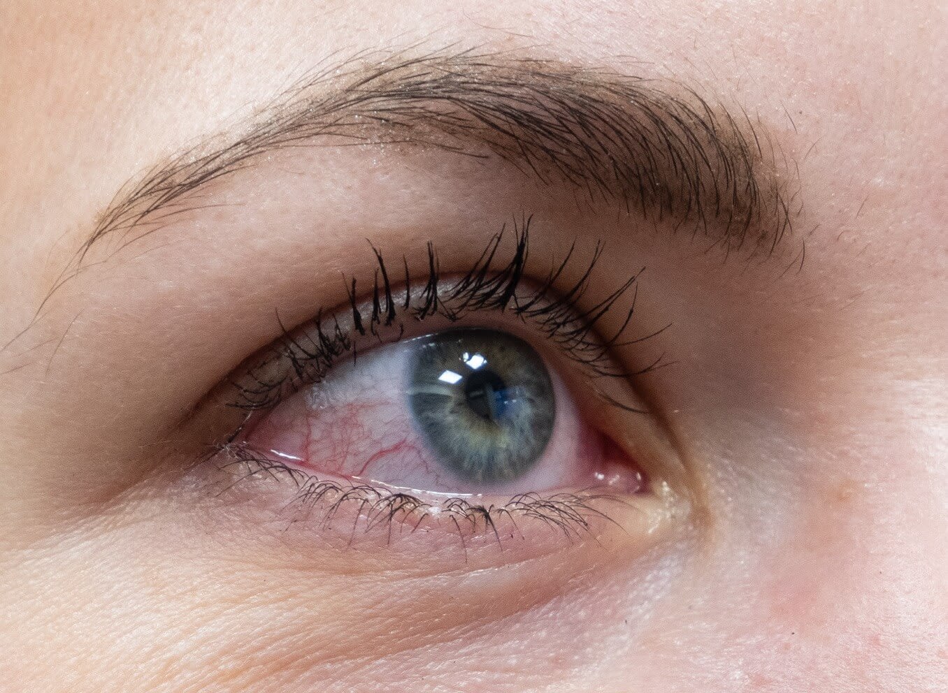 Pink eye irritation from chlorine