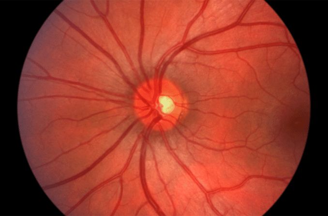 normal optic nerve mri