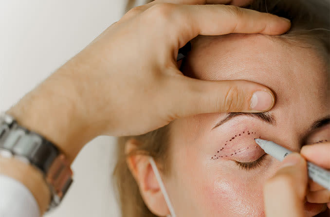 woman prepping for droopy eyelid (ptosis) surgery