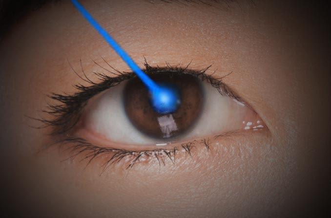レーザー眼科手術の描写
