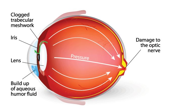 glaucoma eyeball illustration