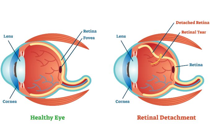 Types of retinal detachment