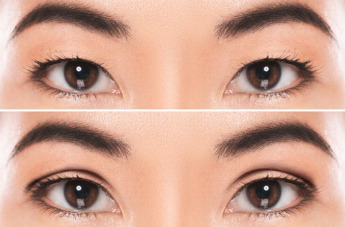 closeup de um conjunto de olhos asiáticos antes e depois da cirurgia de pálpebra dupla