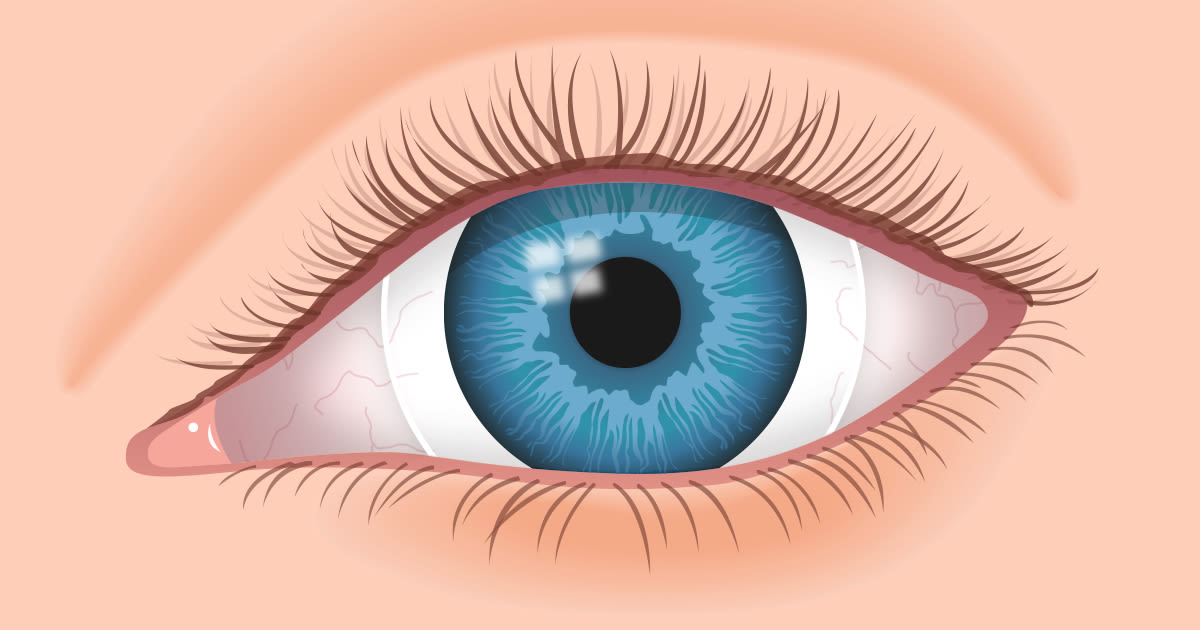 Scleral Contact Lenses For Keratoconus And Irregular Corneas