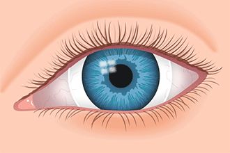 scleral lens in eye