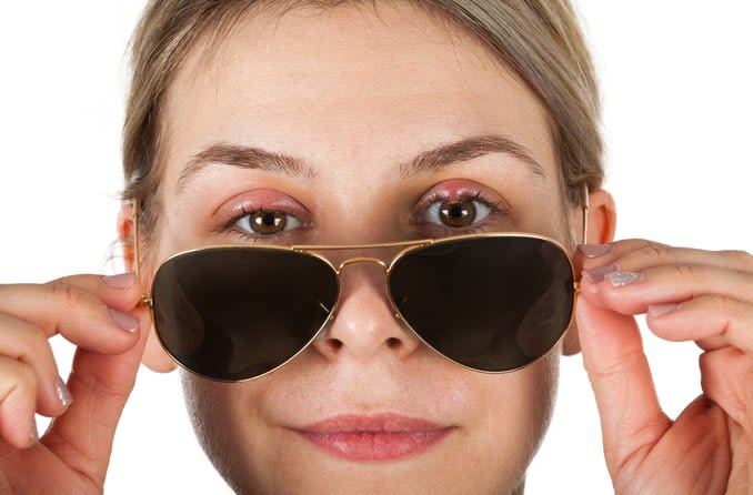 A young woman is slightly lowering her aviator sunglasses to reveal a stye on her left eye.