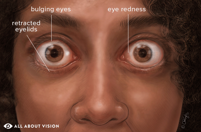 Smitsom sygdom Wrap hvorfor Thyroid Eye Disease - All About Vision