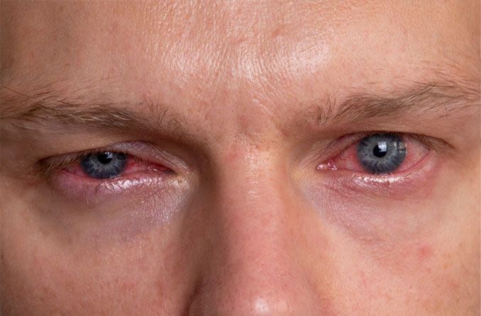 Man suffering from eye discharge from an infection