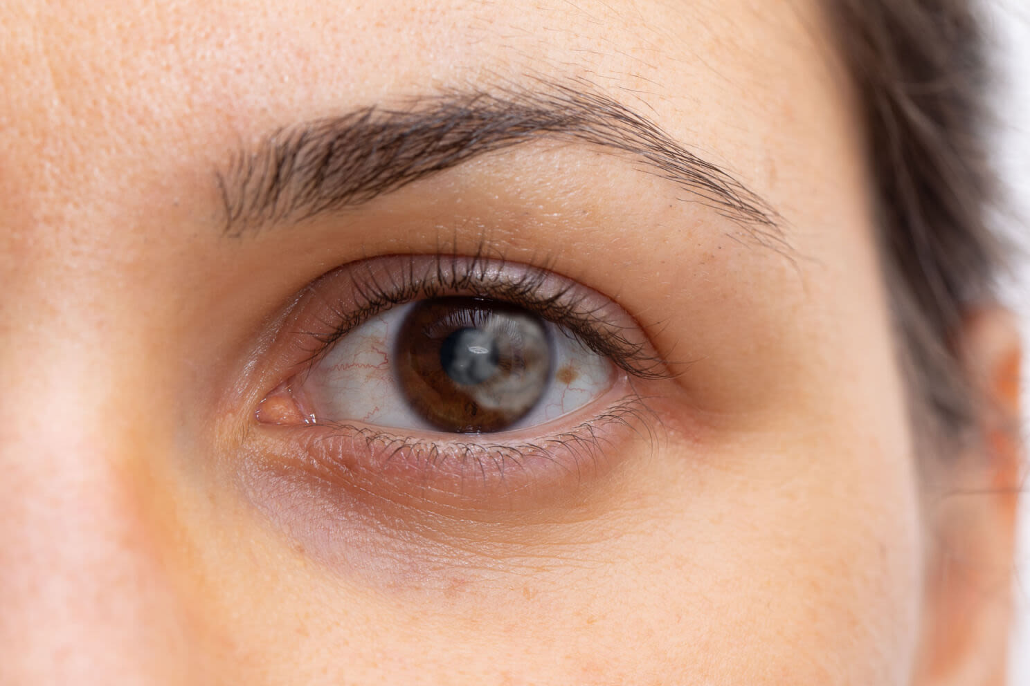 Hyperpigmentation on the white of the eye