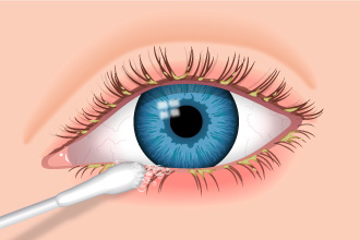 Blepharitis: Eyelid Swelling, Eyelid Inflammation Causes & Treatment