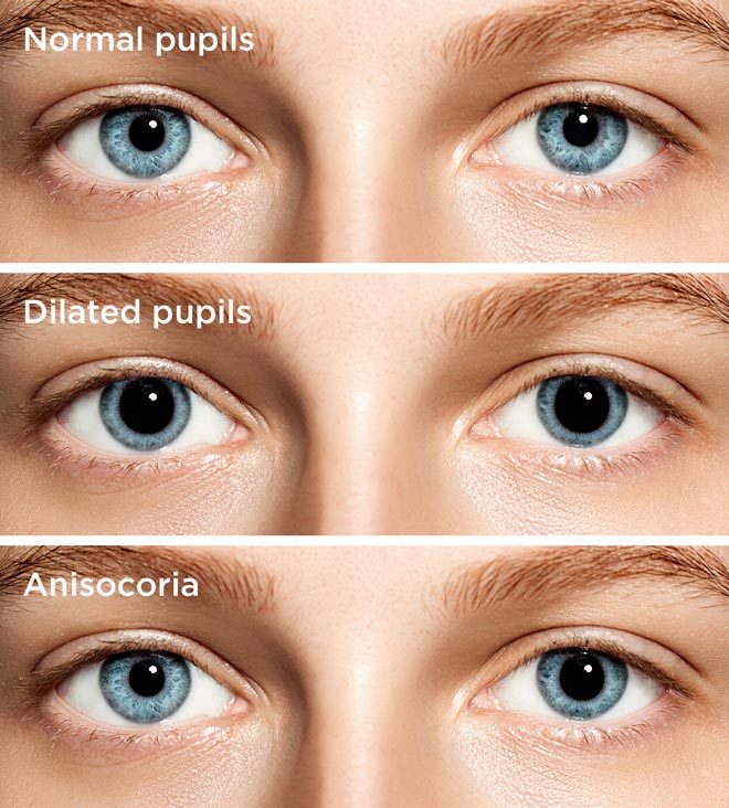 one pupil dilated more than other diuretic