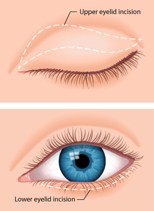 Toronto Blepharoplasty (Eyelid Surgery) | TPS