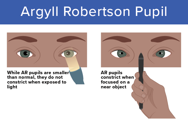 argyll robertson pupil bilateral