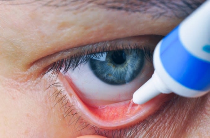 Close-up image of ophthalmic ointment being applied to an eye.