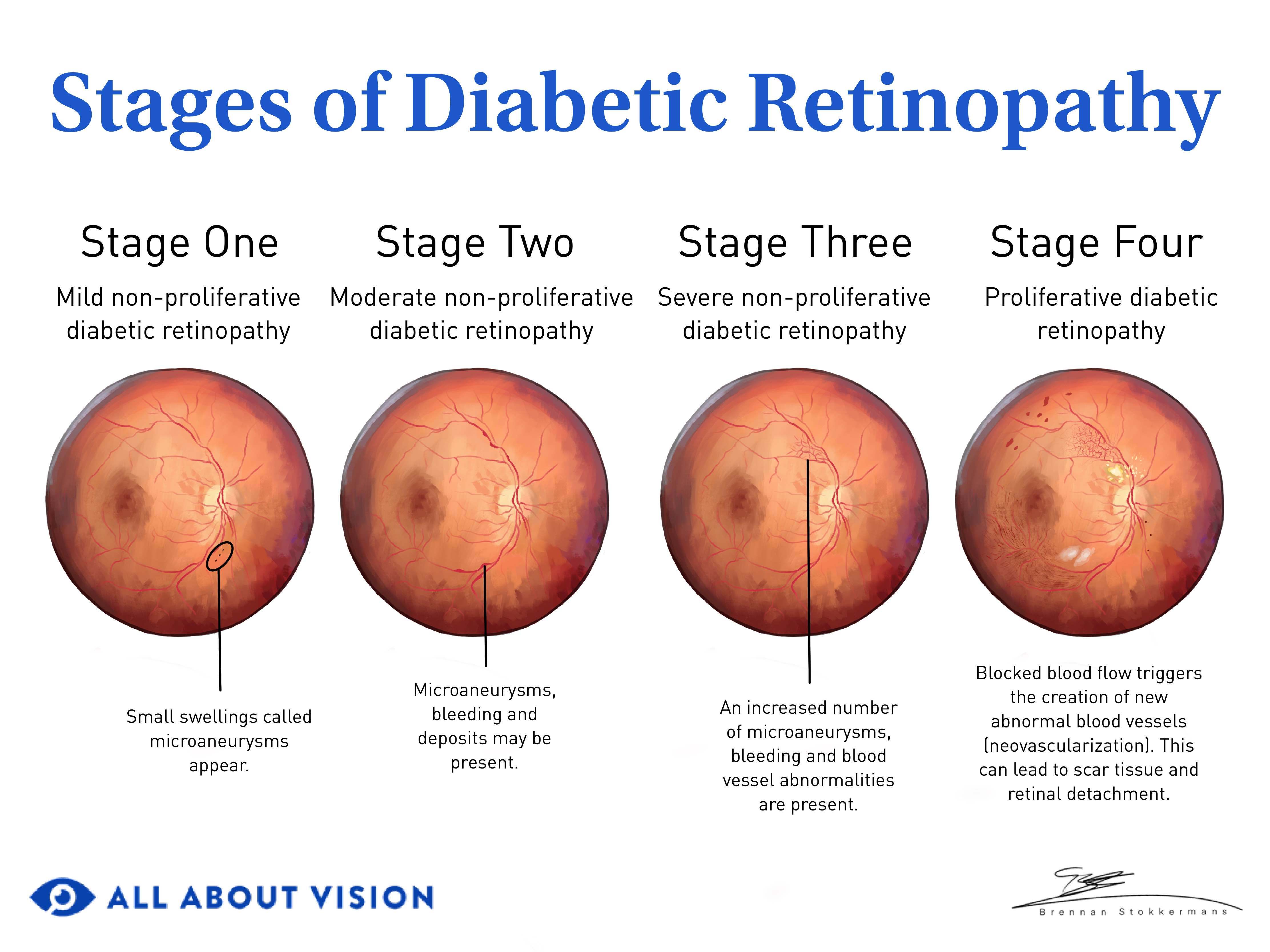 presentation of diabetic macular edema