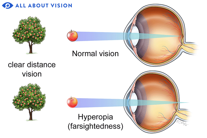 Normal Vision