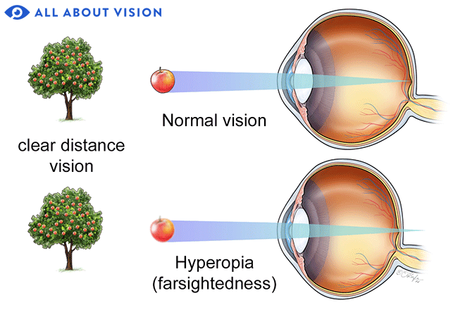 what makes a person near sighted