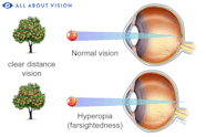 Far Sighted Person Outlet Www katutekno