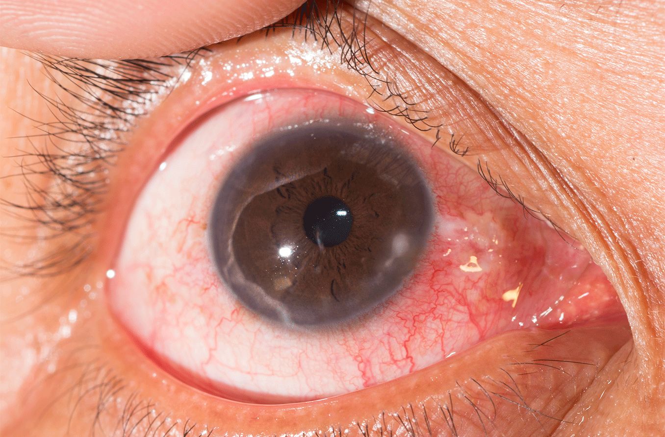 closeup of an eye with fungal keratitis