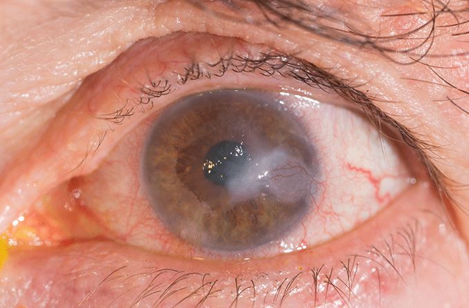 closeup of an eye with fungal keratitis