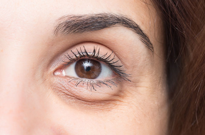 droopy eyelid causes