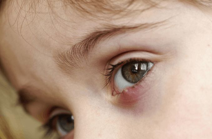 Primer plano del ojo de un niño con un orzuelo