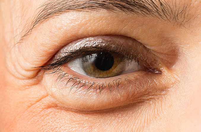 Tranen balans mesh Puffy Eyes: Causes and How To Get Rid of Puffy Eyes