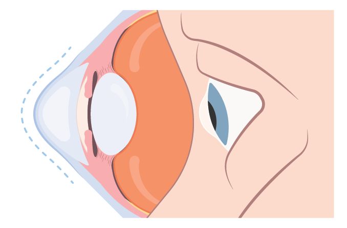 illustration of a type of corneal disease called keratoconus