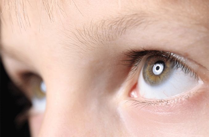 closeup of young child's eyes undergoing nystagmus treatment