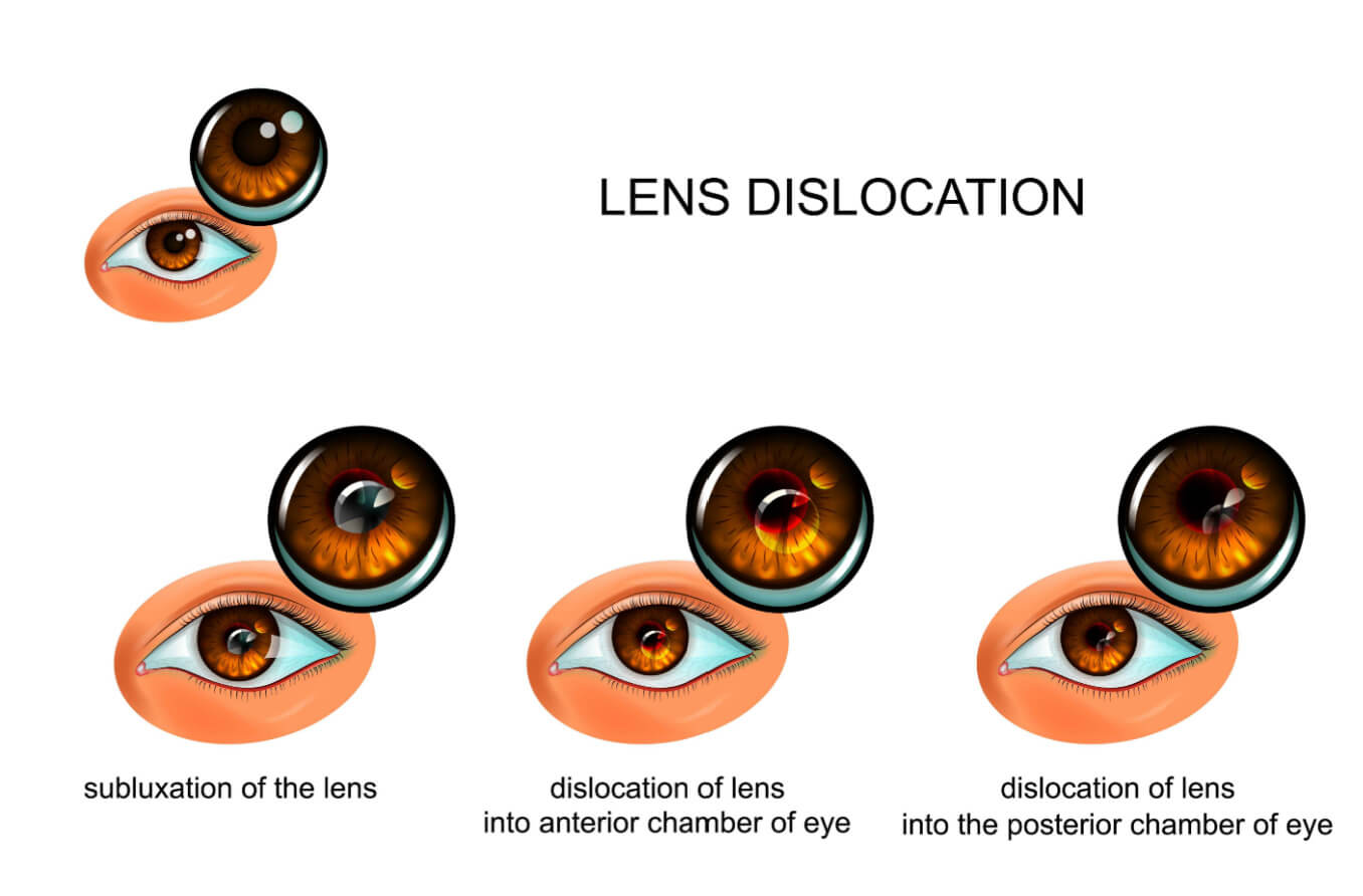 Illustration of a dislocated lens of the eye