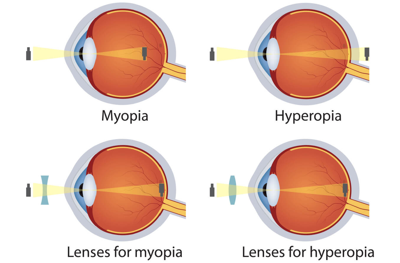 Hyperopia and myopia corrected by lens