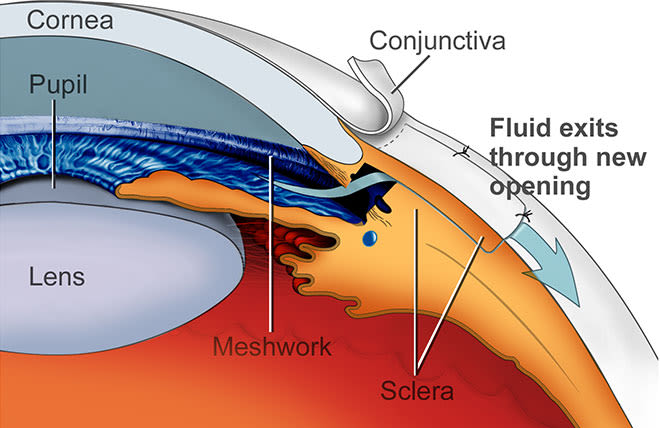 https://cdn.allaboutvision.com/images/glaucoma-surgery-diagram-nei-660x428.jpg