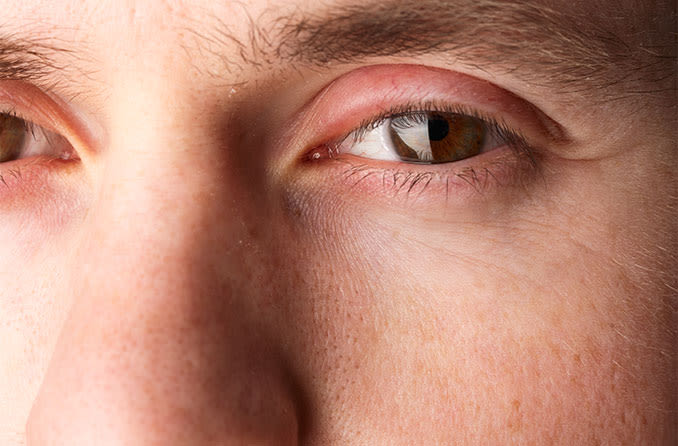 man with a swollen eyelid