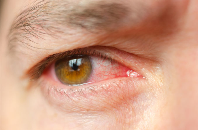 eye-infections-what-should-you-do