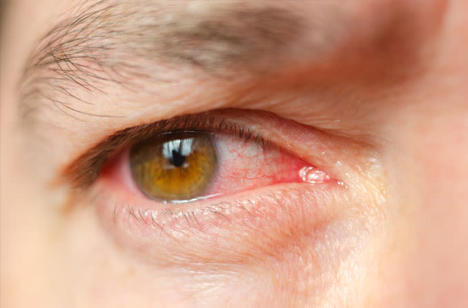Раздражение глаз из-за инфекции